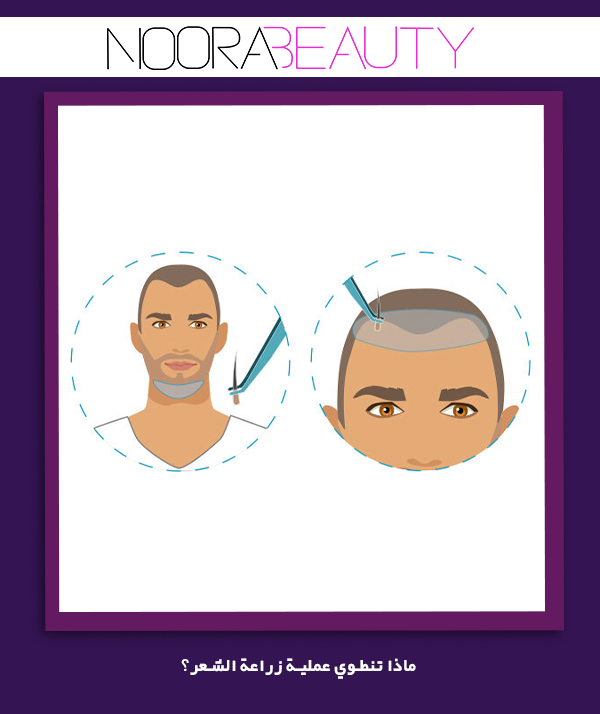 ماذا تنطوي عملية زراعة الشعر؟