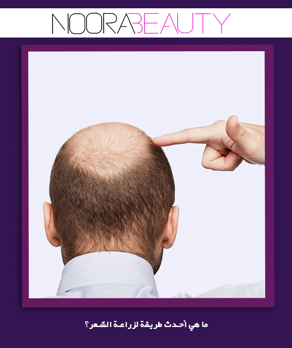   ما هي أحدث طريقة لزراعة الشعر؟