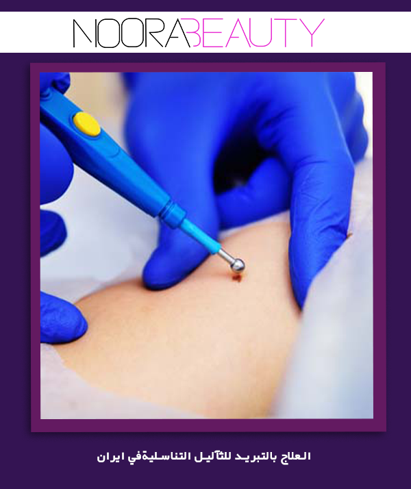 العلاج بالتبريد للثآليل التناسليةفي ايران