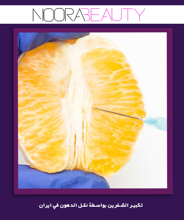 تكبير الشفرين بواسطة نقل الدهون في ايران